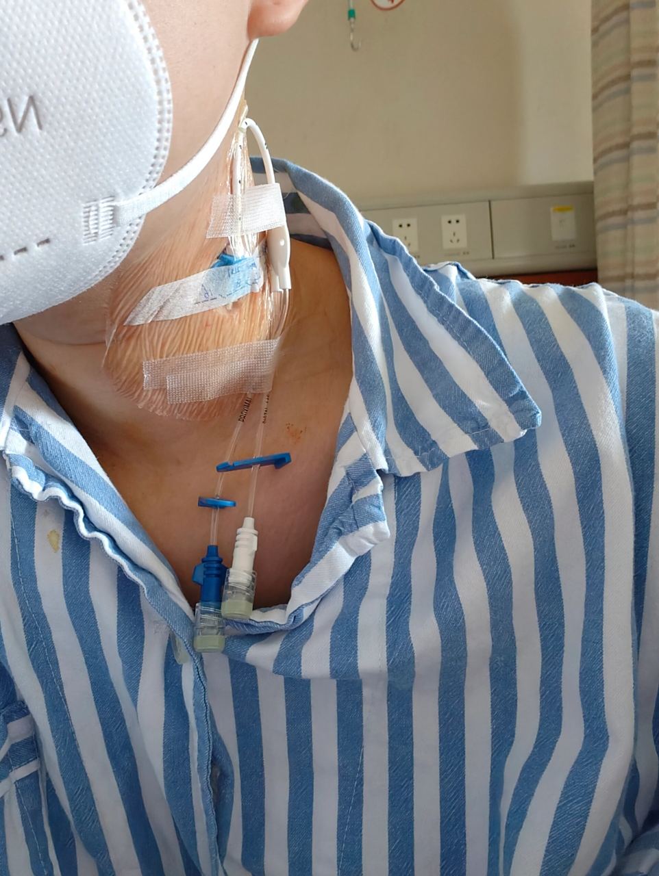 深静脉置管 躺下痛,找不到合适的睡姿