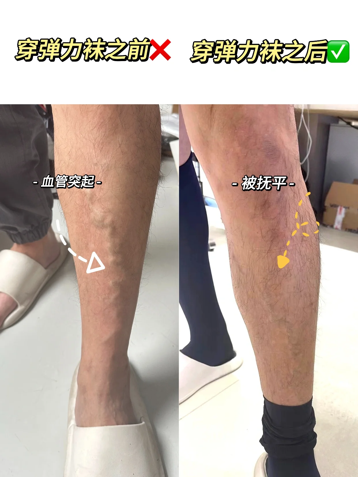 男士静脉曲张也有专用袜🧦了!