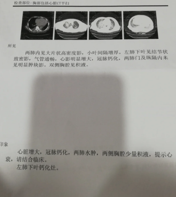 无锡肺炎病例(无锡肺炎病例最新消息) 无锡肺炎病例(无锡肺炎病例最新消息)