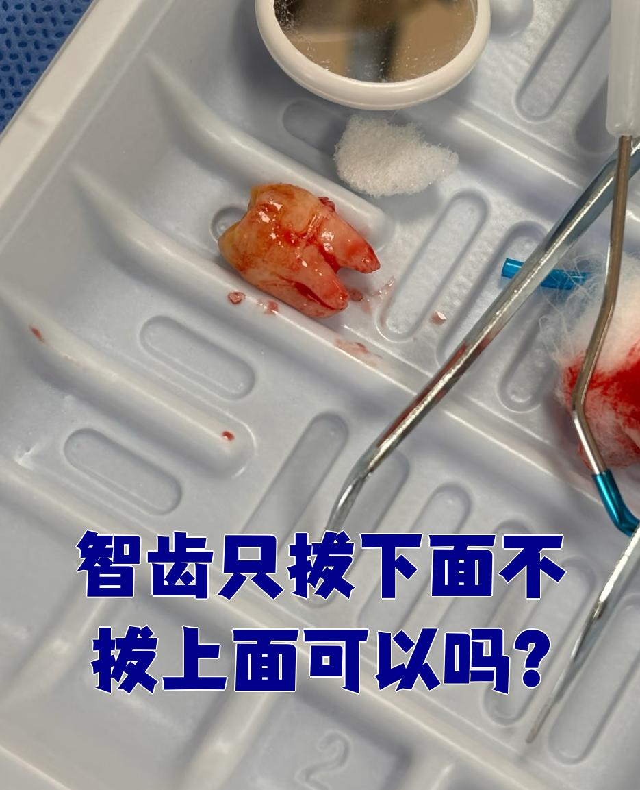 智齿只拔下面不拔上面可以吗?