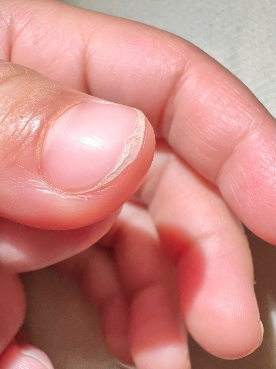 宝宝指甲分层是什么原因 2岁的孩子,两个大拇指,和大脚趾的指甲盖都