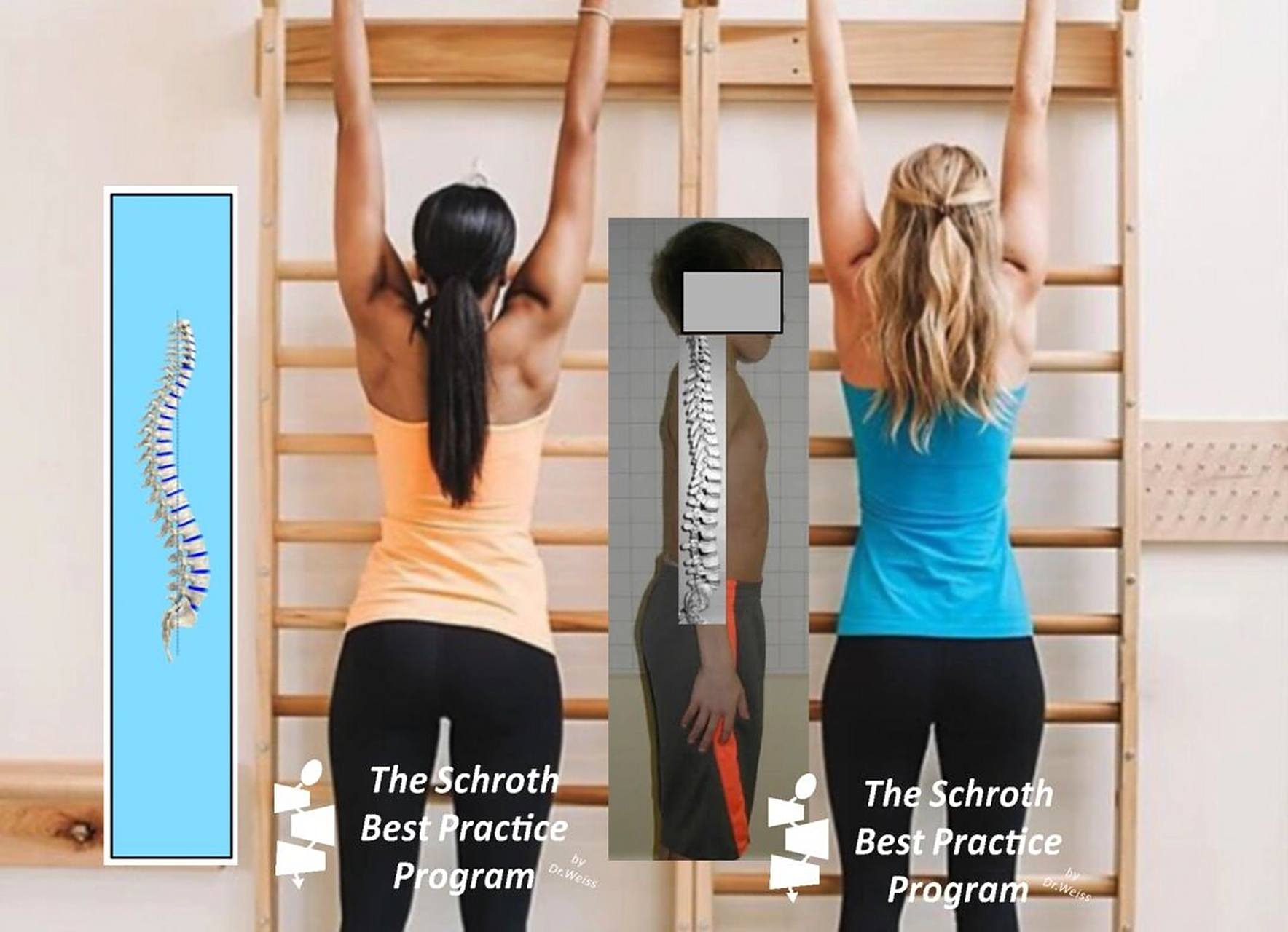 吊单杠能够矫正脊柱侧弯?