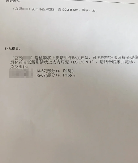 宫颈鳞状上皮轻度异型增生是一种低级别的癌前病变,主要是由人乳头