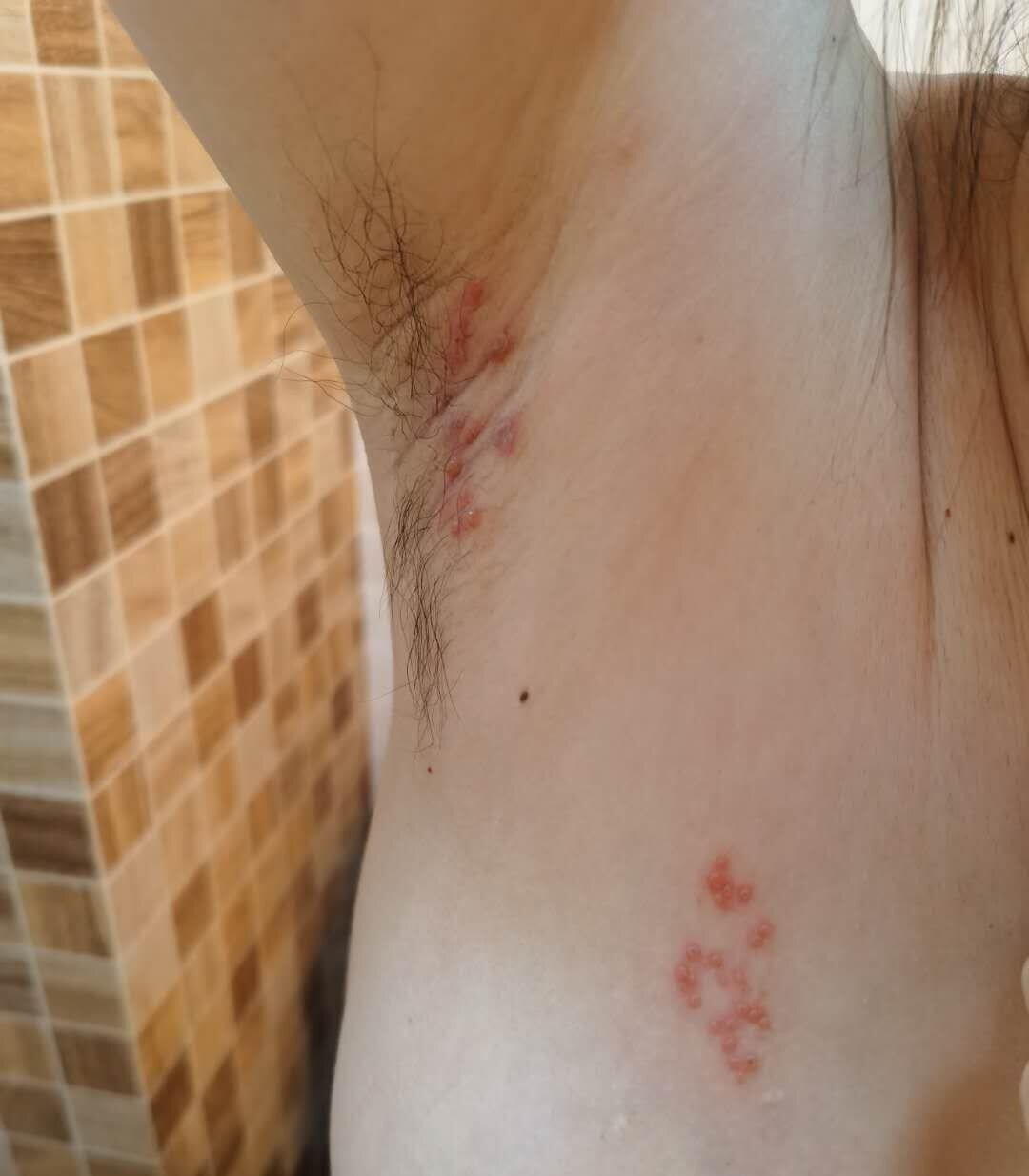 哺乳期带状疱疹,有图慎入