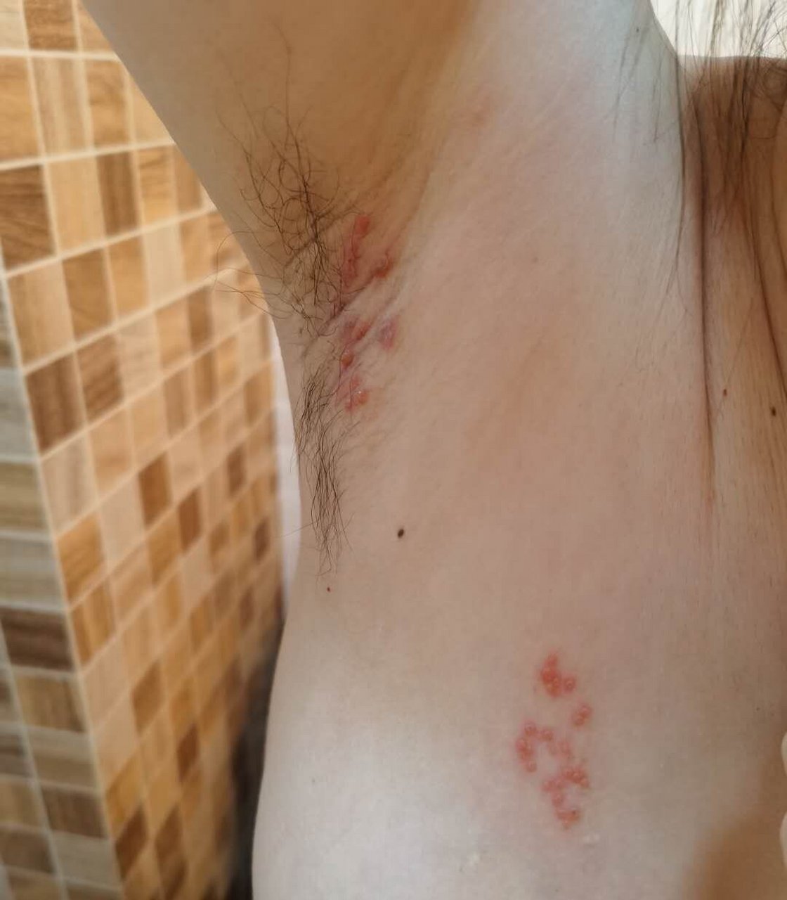 哺乳期带状疱疹,有图慎入 腊月二十八那天晚上洗澡发现腋下长了几个