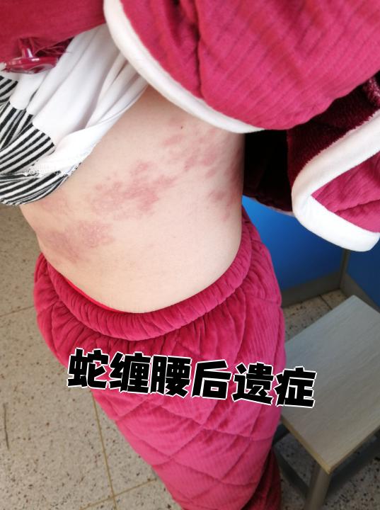 蛇缠腰的后遗症主要是神经性疼痛,必须及时治疗才能