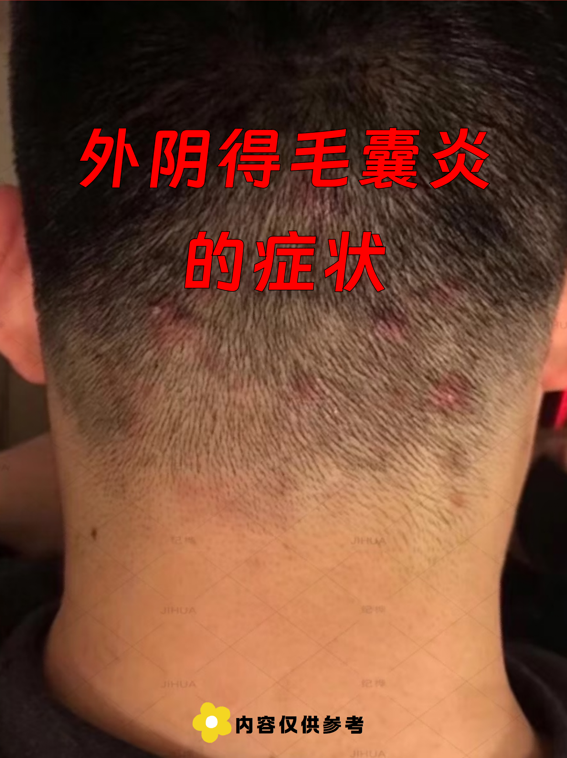 外阴毛囊炎是常见的皮肤感染问题,常因细菌侵入