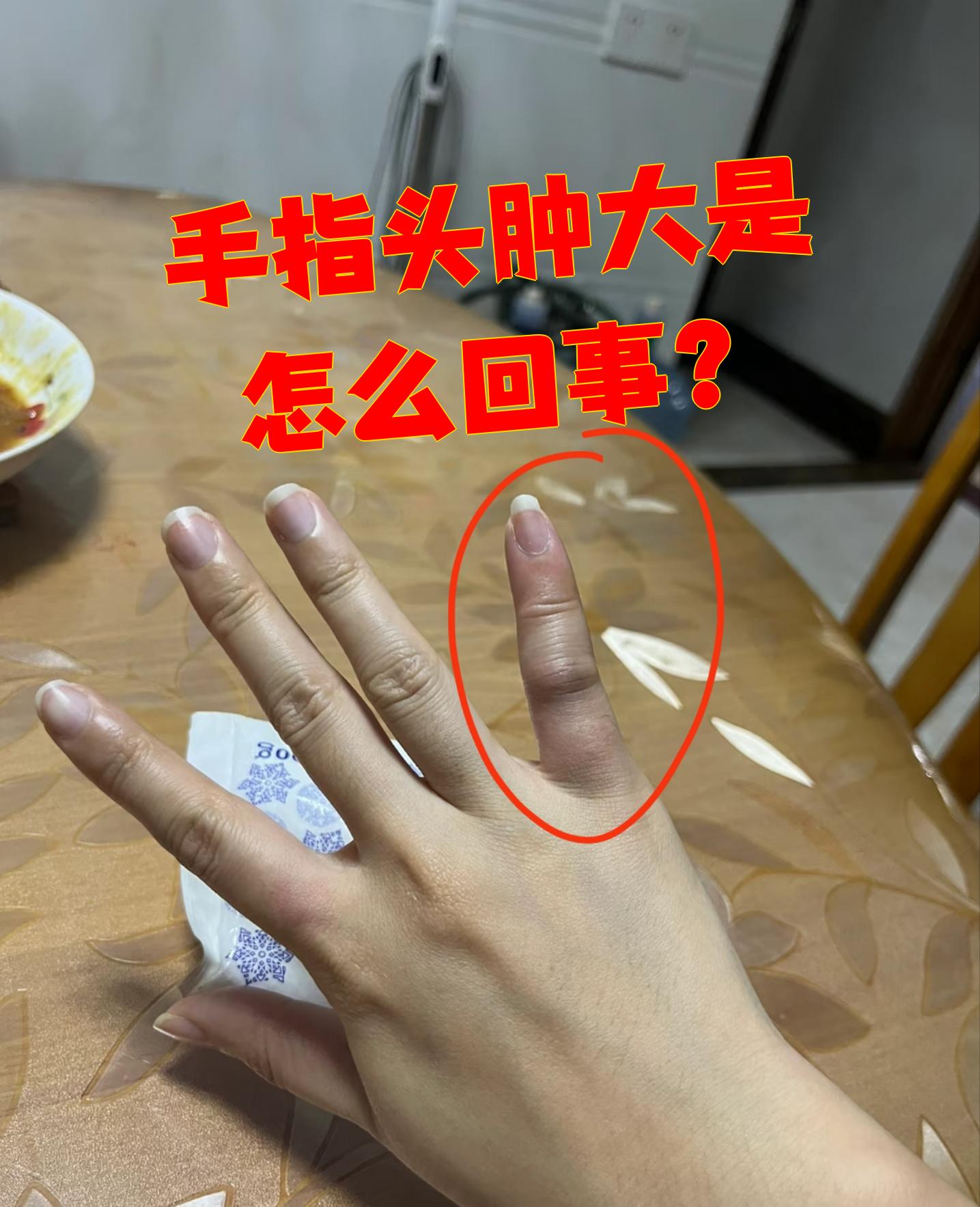 炎手指有什么症状关节炎图片手指头关节手指关节炎变形图片银屑病手指