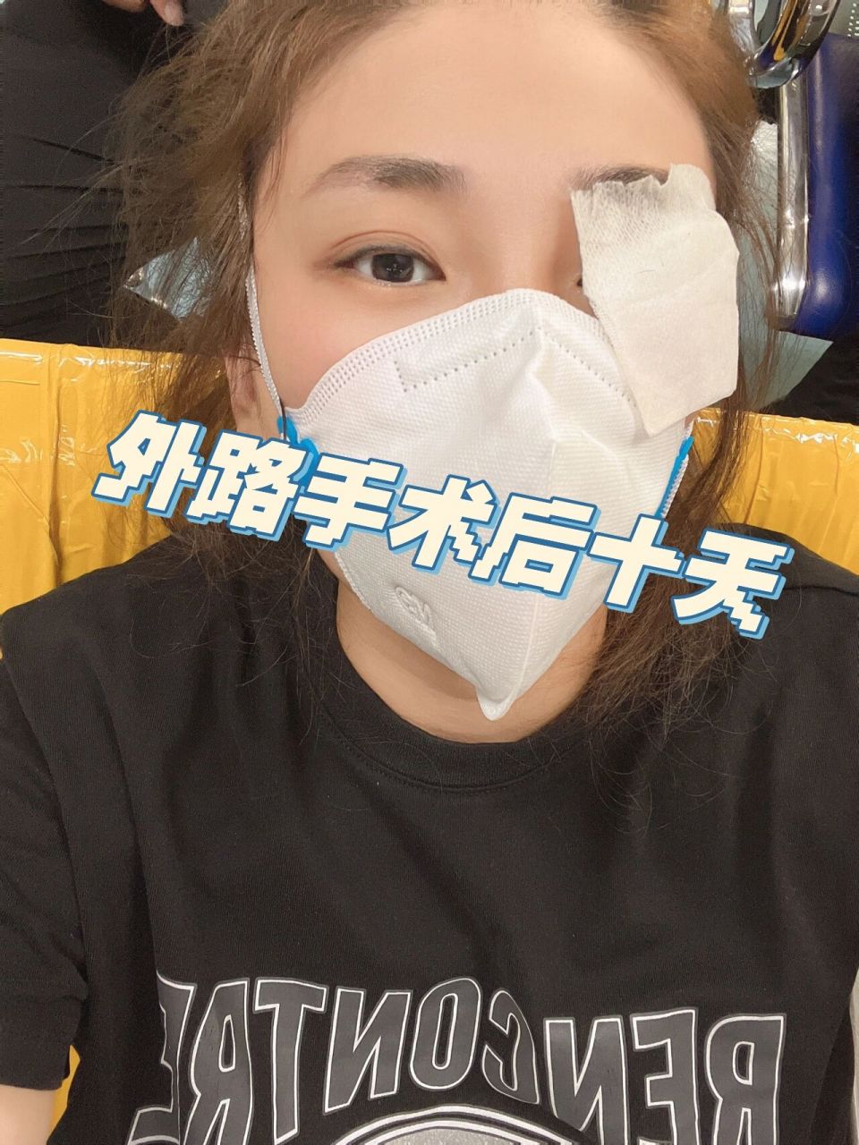 视网膜外路手术后十天 今天术后十天了,眼睛由于散瞳,只要不睡觉24