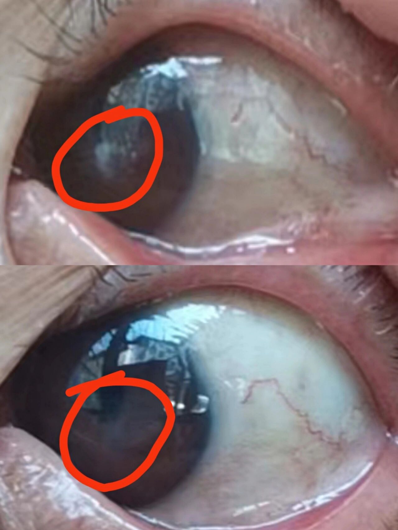 病毒性角膜炎造成的角膜白斑