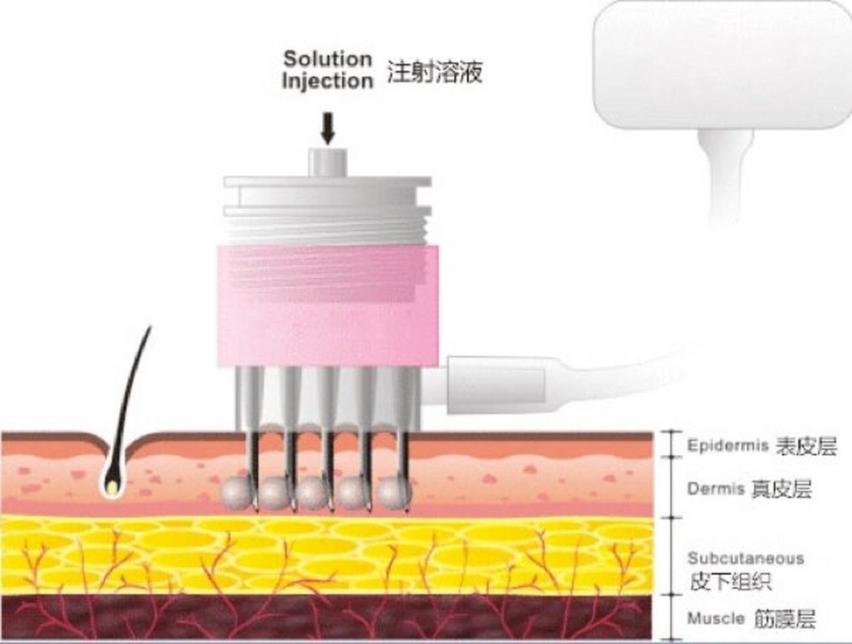 玻尿酸注射原理图片