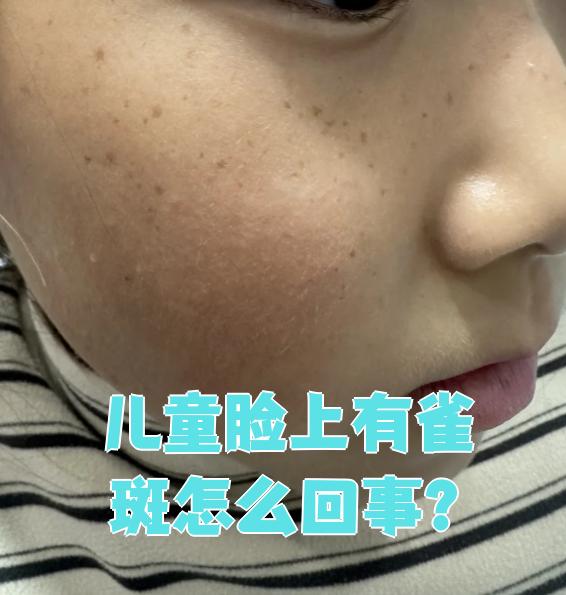 孩子脸上长雀斑主要有三个常见原因:遗传,晒太阳太多,或者可能是红斑
