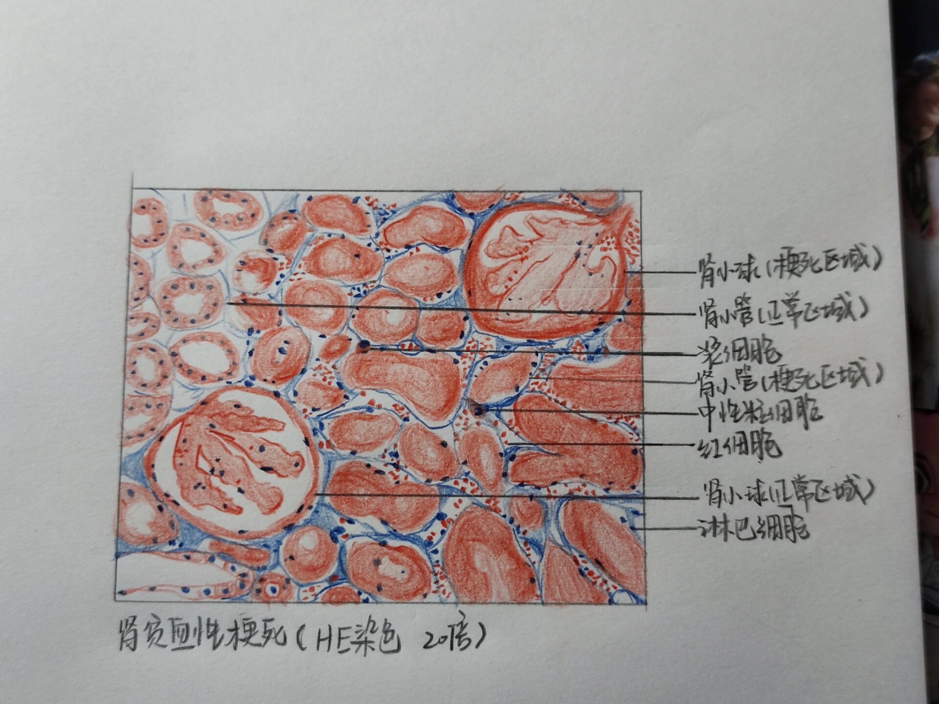 肾梗死病理图片