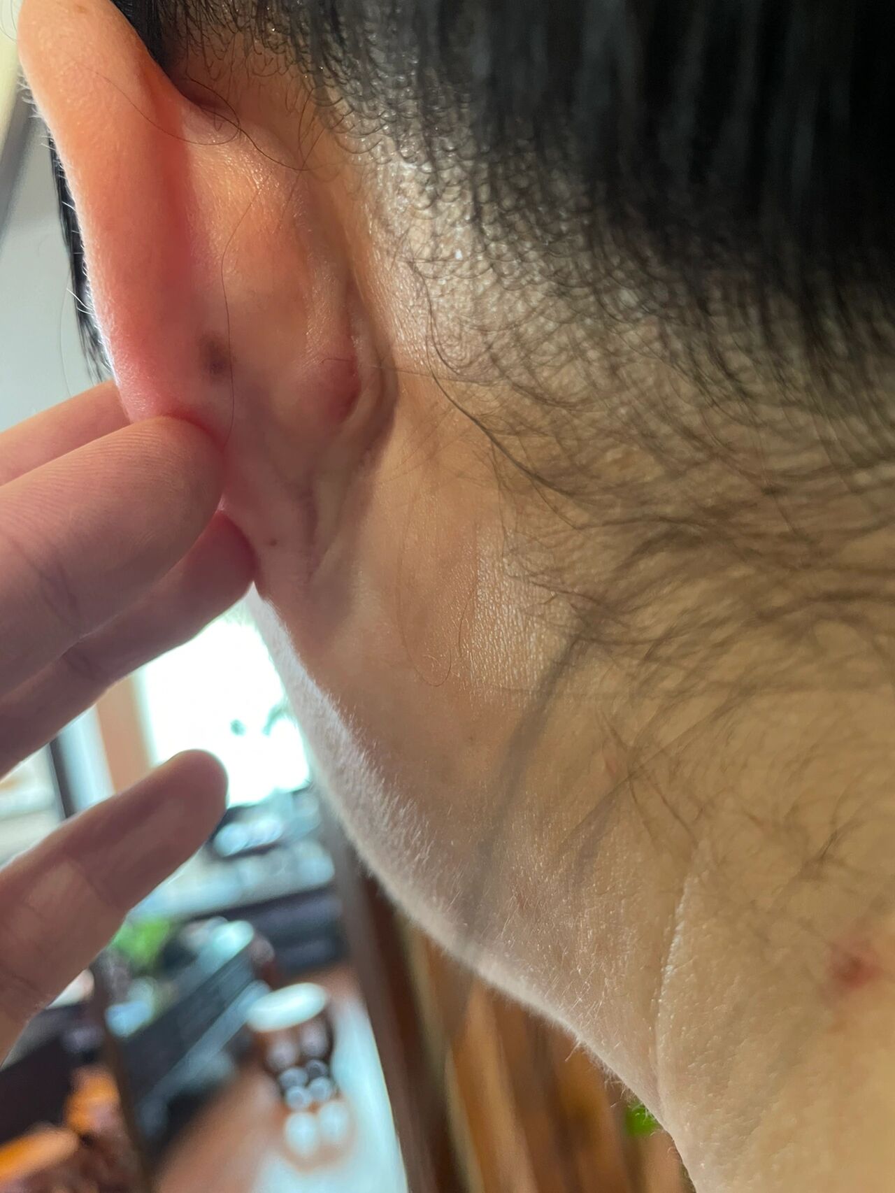 有懂医理的朋友吗帮忙看看耳后什么情况