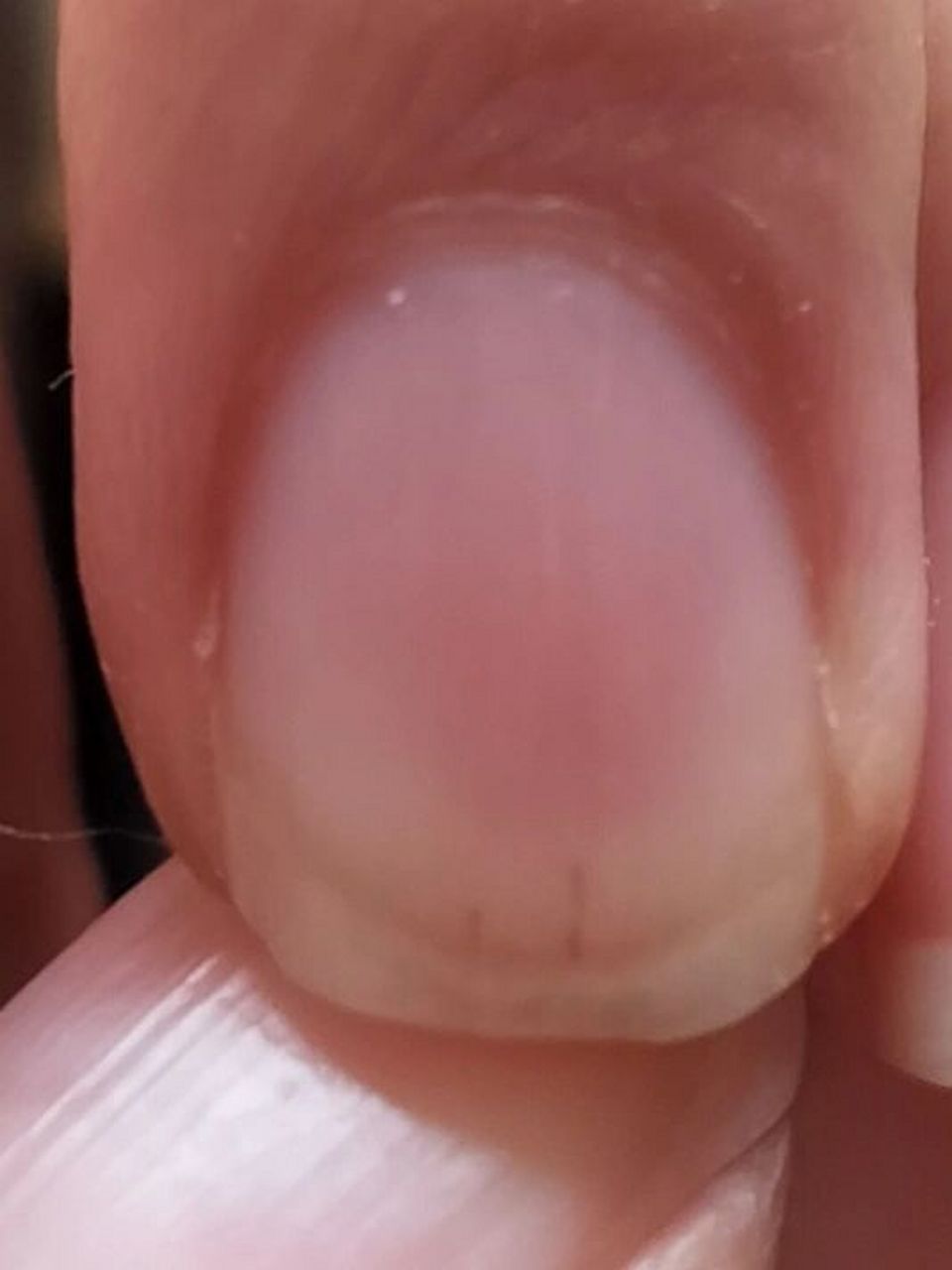指甲上有两条黑线,图一是昨天早上拍的,图二今天下午拍的,这是咋了
