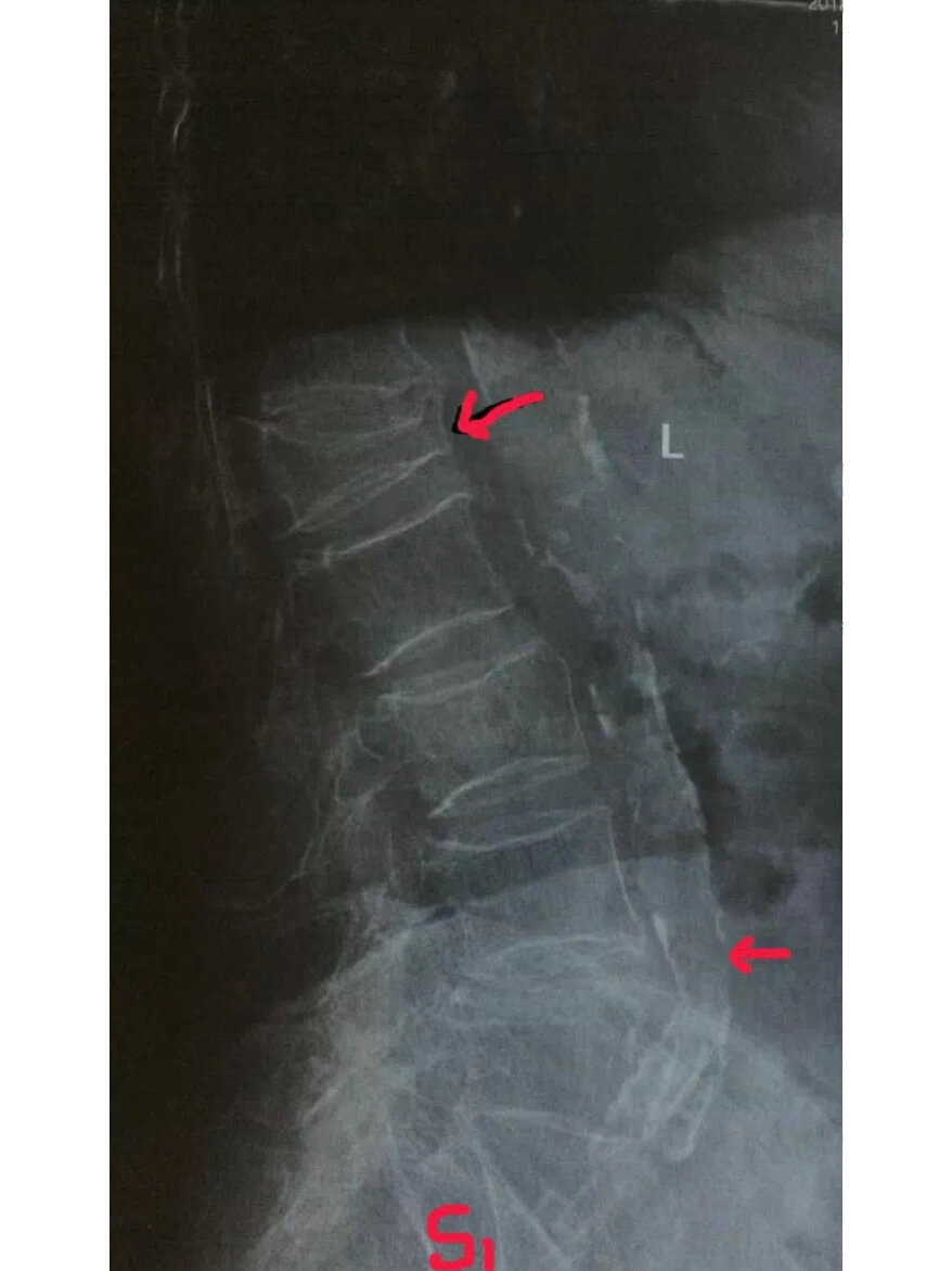 腹主动脉钙化,骨质疏松和l1压缩性骨折 转发同行照片.