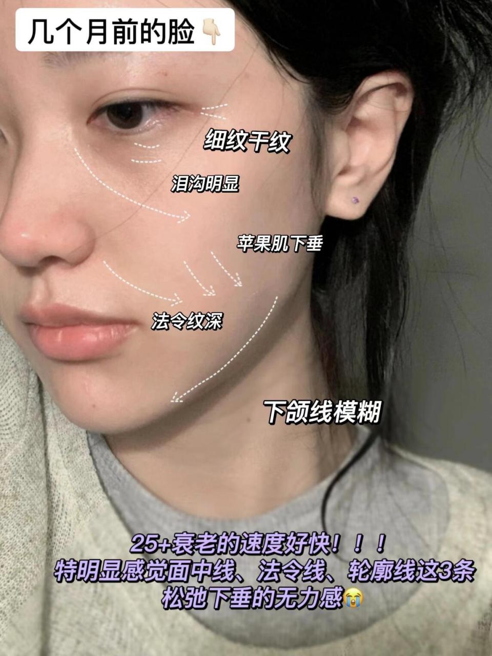 救命啊98 我发现常年熬夜真的会脸垮 尤其眼下的细纹 法令纹都在变
