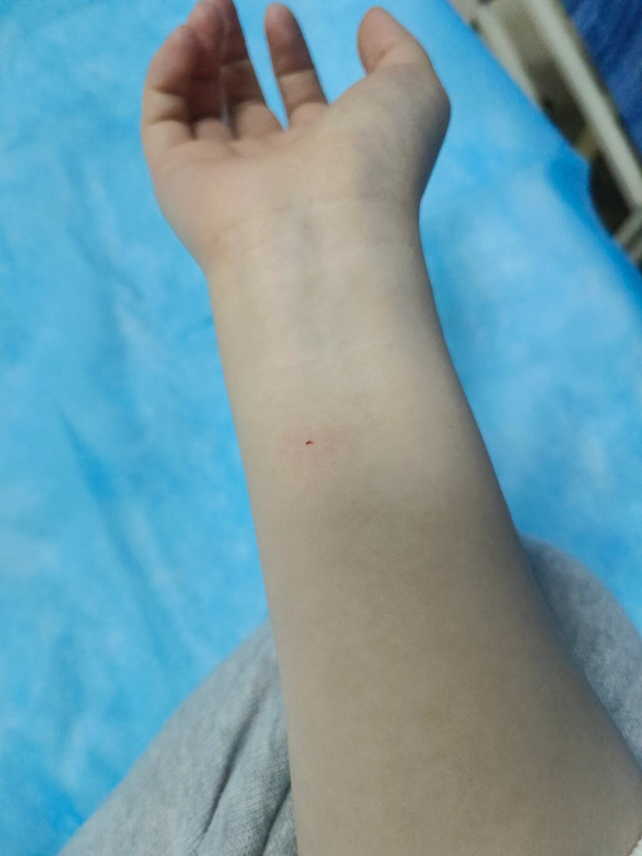 30岁第一次知道皮试过敏的样子 扁桃体化脓,头孢皮试.