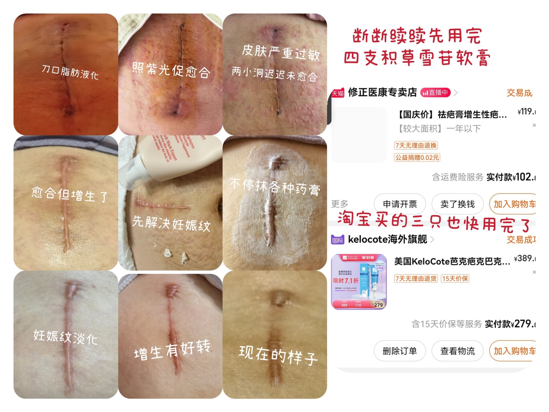 关于剖腹产疤痕增生真实的样子!拒绝焦虑!