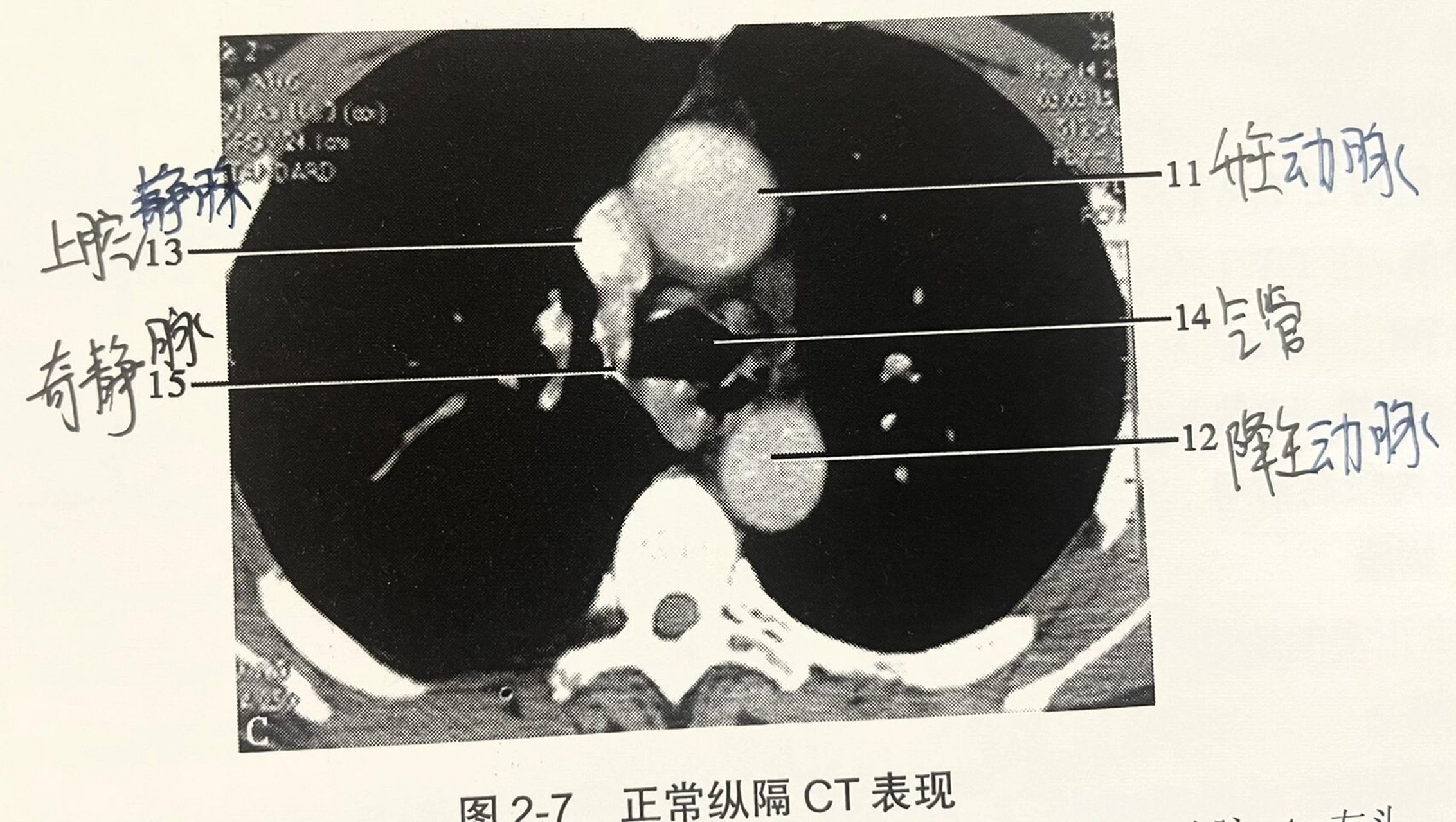 纵隔窗ct图图片