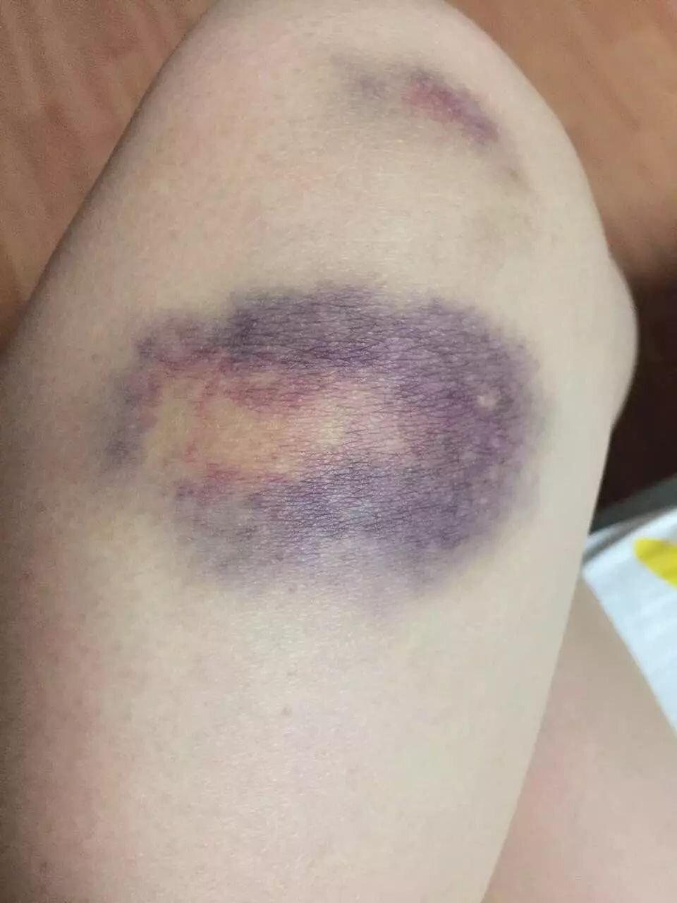 你们身上也会无缘无故有淤青吗?