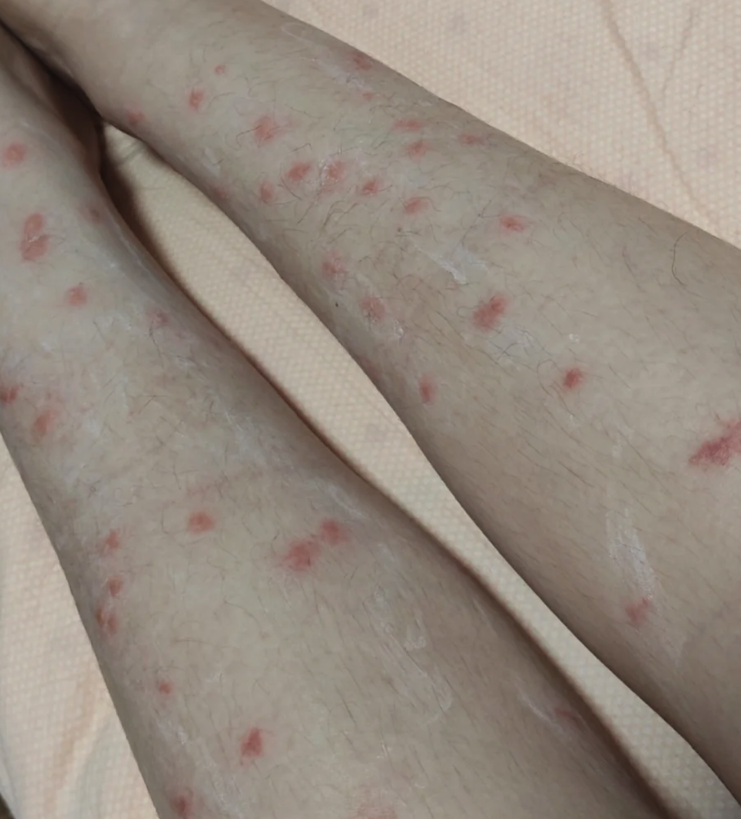 腿上被虫子咬了以后出现红肿,痒,起水泡,这通常是虫咬性皮炎