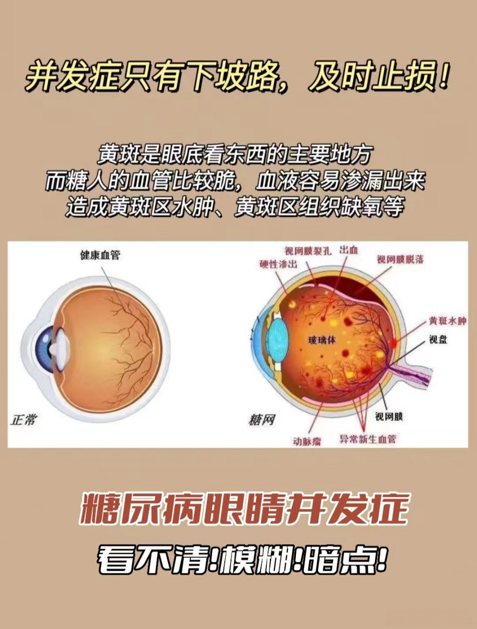 糖尿病眼睛并发症!看不清!视力模糊!