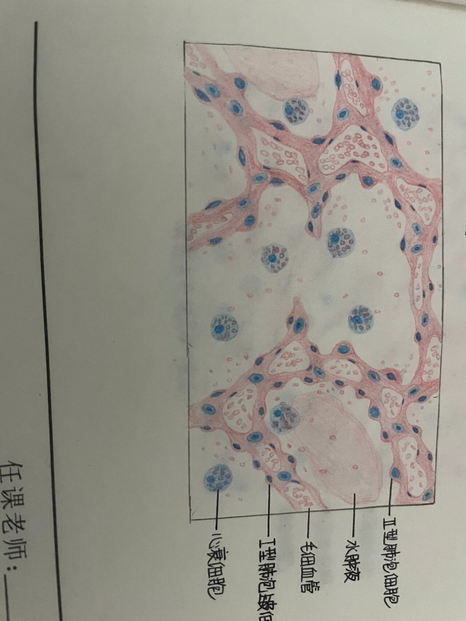 局部血液循环障碍 病理红蓝铅笔手绘图 肝淤血99(靠近中央静脉肝