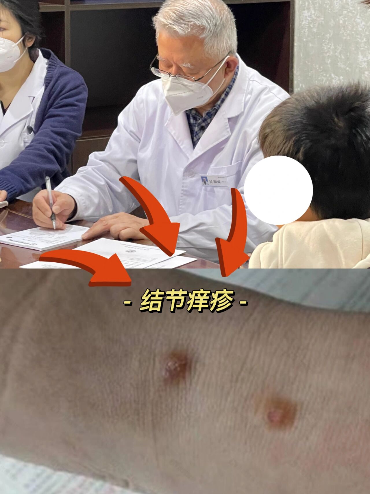 结节性痒疹基本的症状有什么