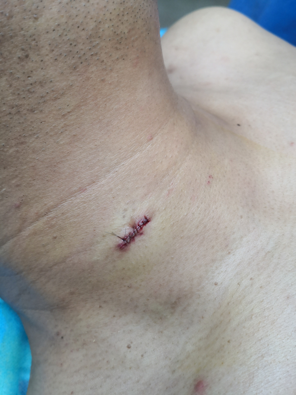 颈部和背部皮样囊肿,手术切除治疗.