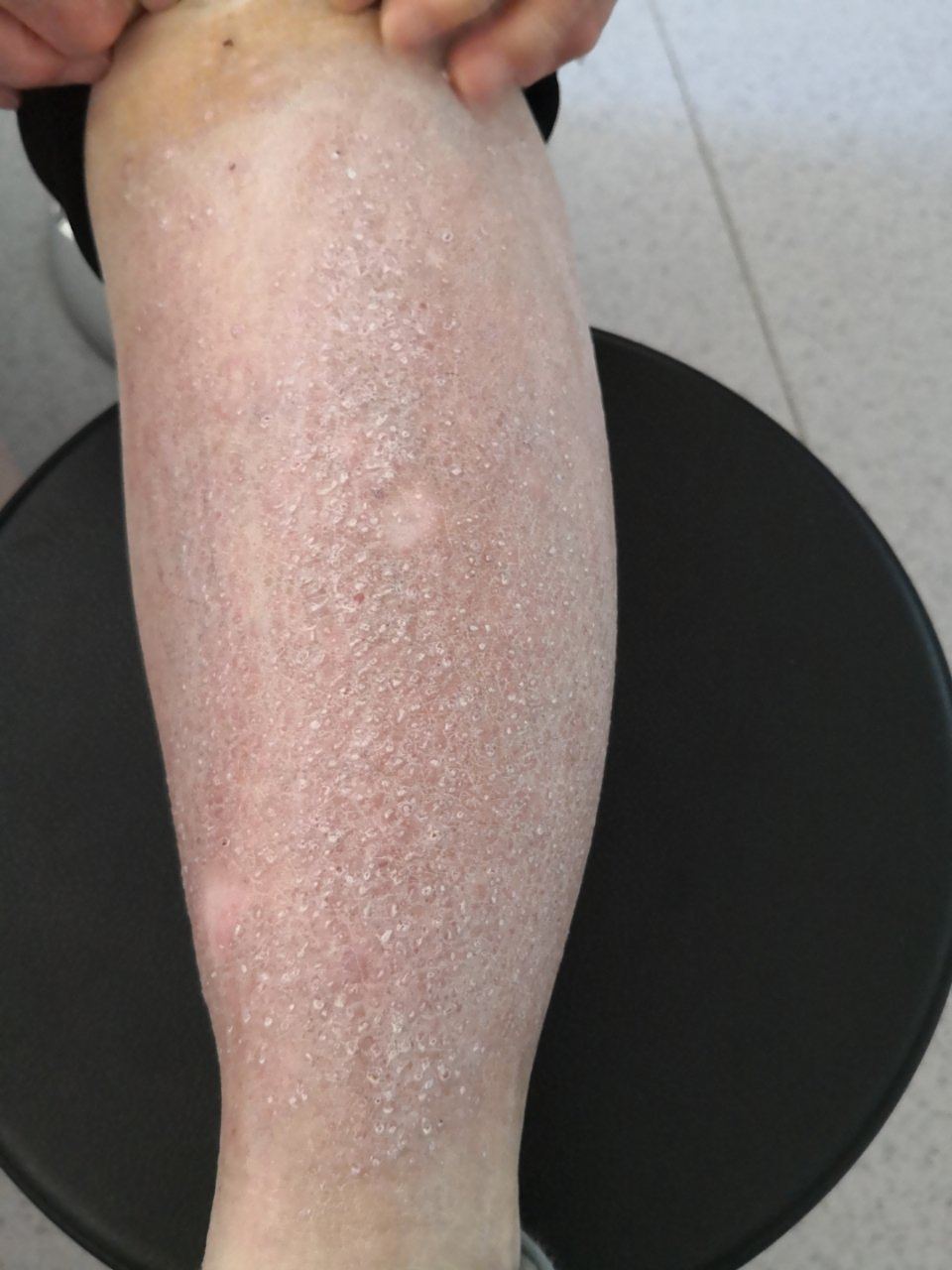 老年女性小腿密集丘疹结节斑块症状#解决皮肤问题专注皮肤美容##皮肤