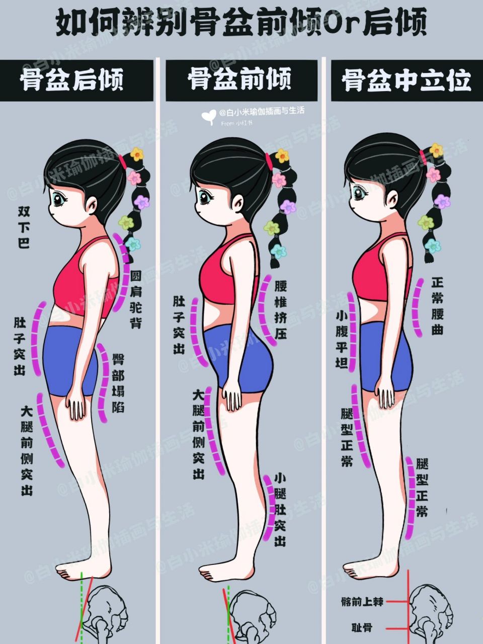 体态|骨盆前倾?后倾?