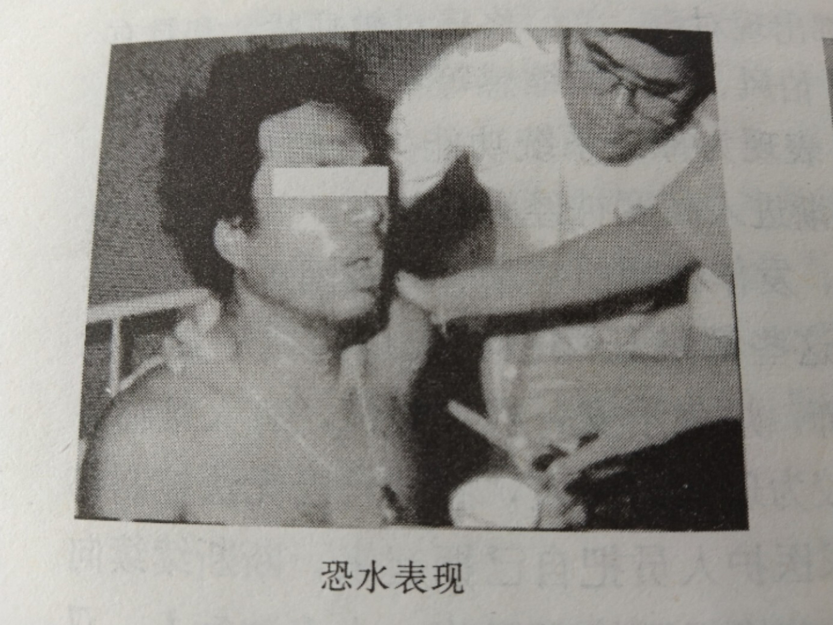 狂犬病人的临床表现