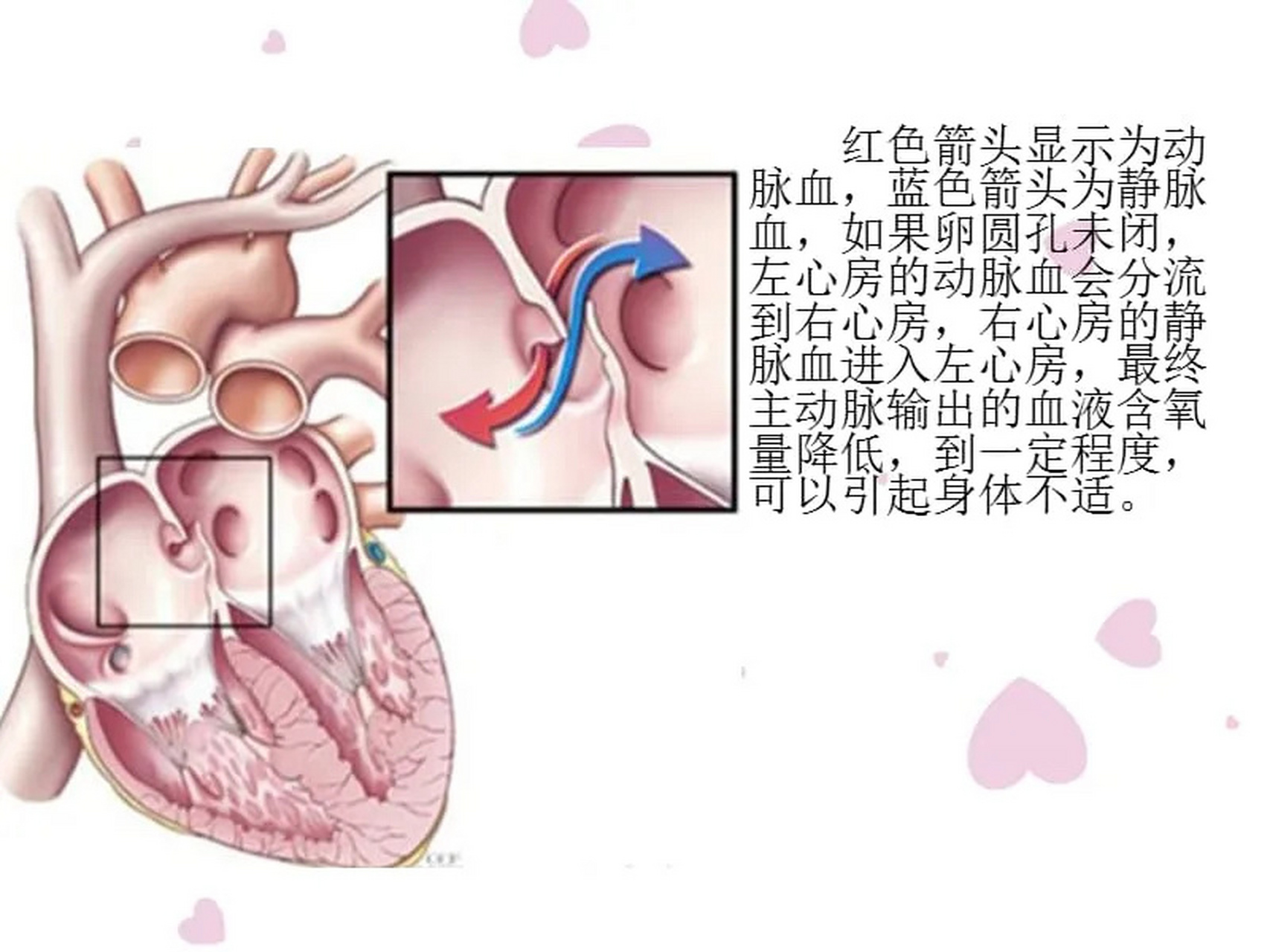 一图看懂卵圆孔未闭 卵圆孔位于房间隔的中下部,是胎儿期左房和右房