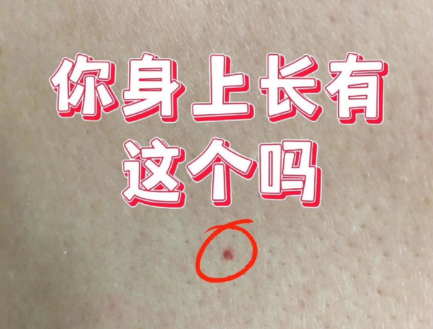 这个学名叫"樱桃状血管瘤",还有一个不好听的名字老年性血管瘤,因为