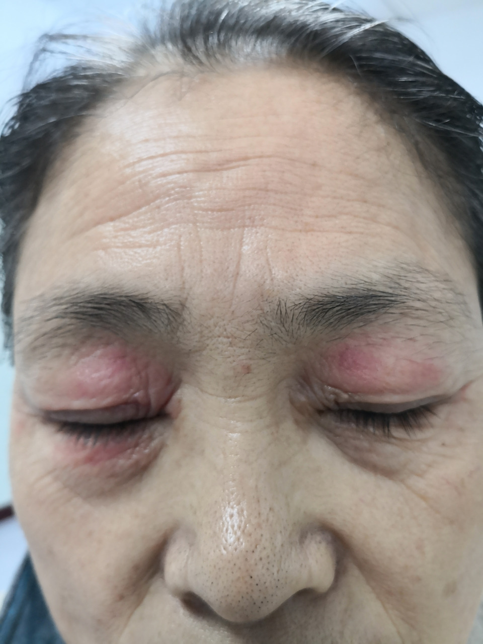 眼睑肿胀红斑干燥瘙痒症状.自行涂擦药膏引起的接触性皮炎.#过敏