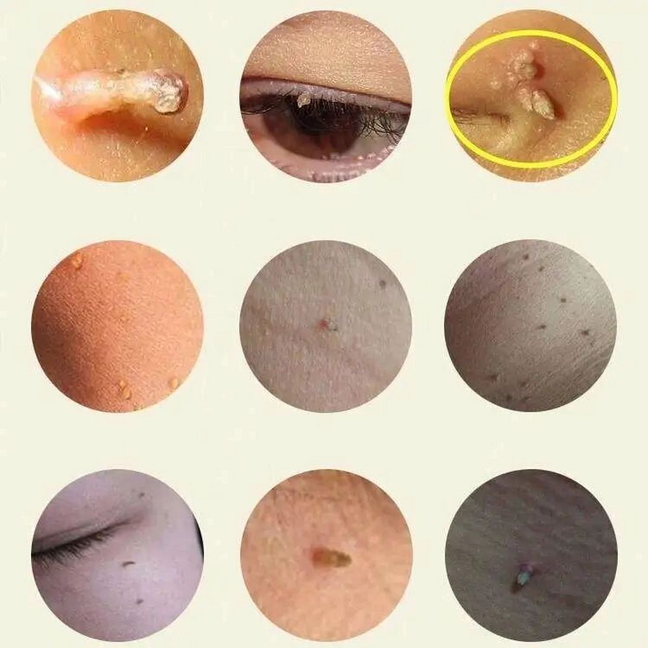 如何判断是不是得了扁平疣 扁平疣在现在生活中也算是一种比较常见的