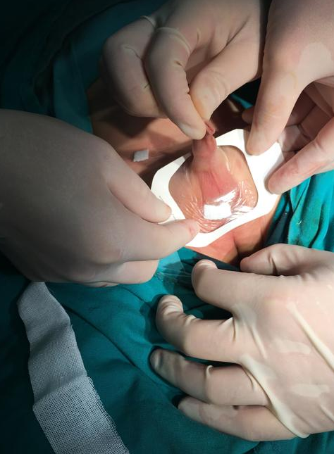 婴儿睾丸没掉下来可能是隐睾,这通常和内分泌问题,睾丸下降异常贿者