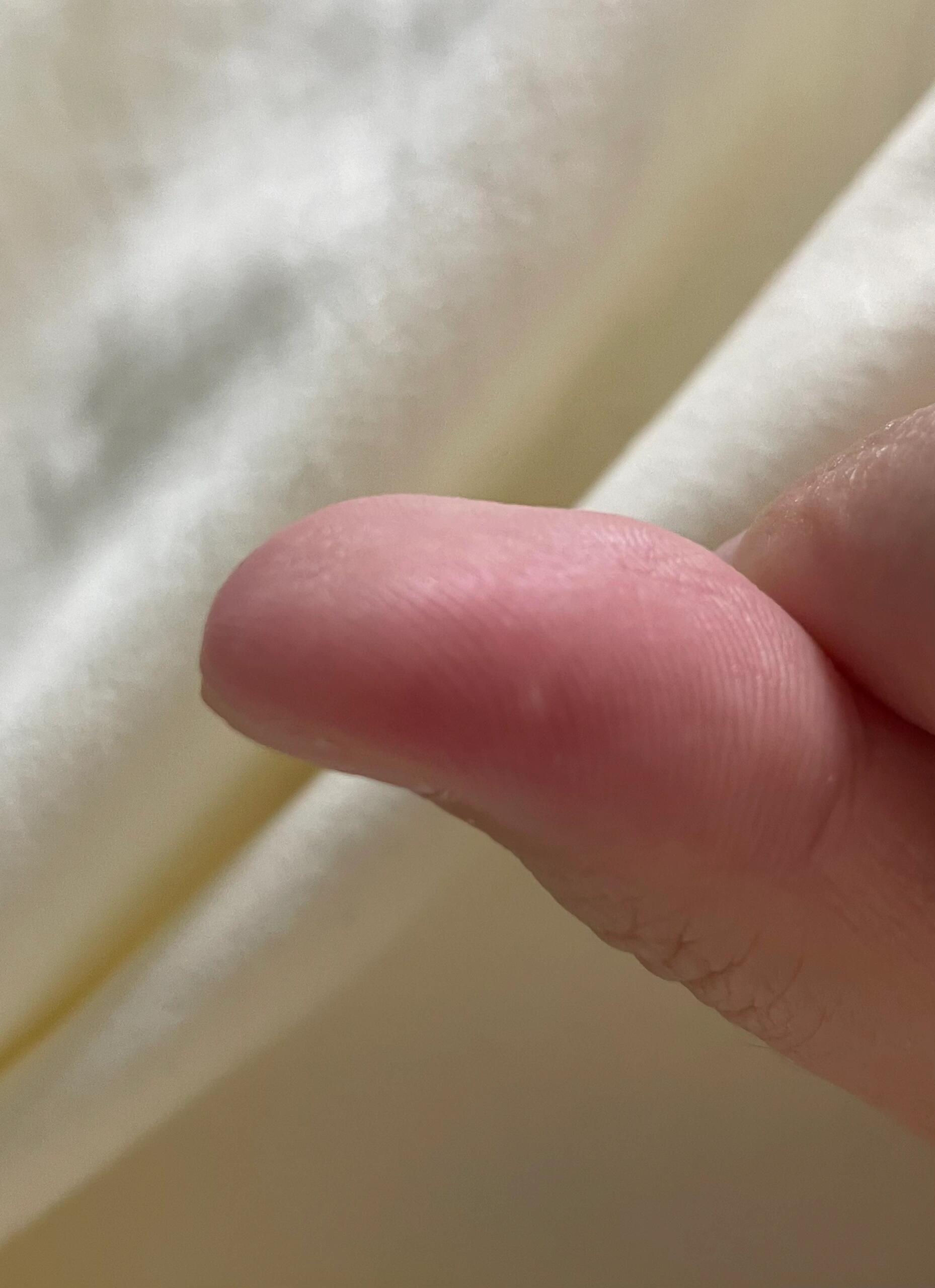 这是什么 半个月了,大拇指出现一个小白点,硬的,一开始感觉像扎东西了