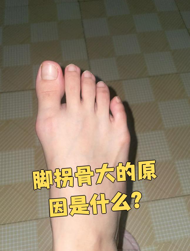 脚拐骨大最常见的原因是拇外翻,也可能是大骨节病或骨质增生导致. 