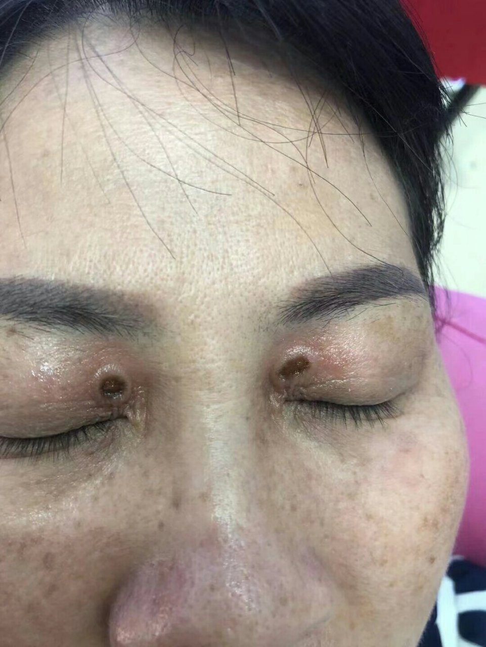 这叫睑黄疣 睑黄疣