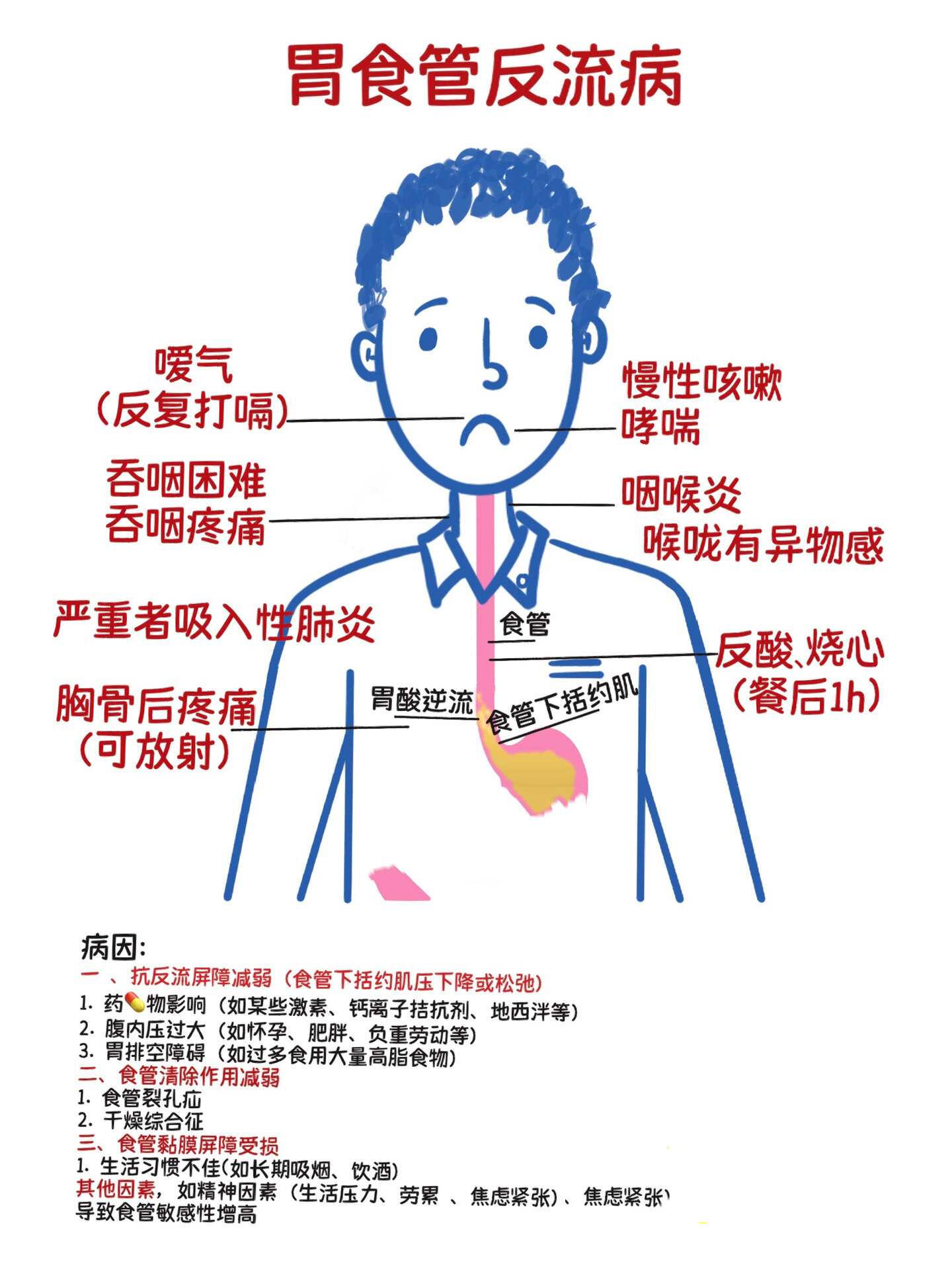 科普58 | 胃食管反流病症状,病因及zhi 疗