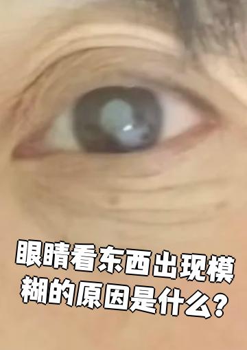 眼睛模糊为什么