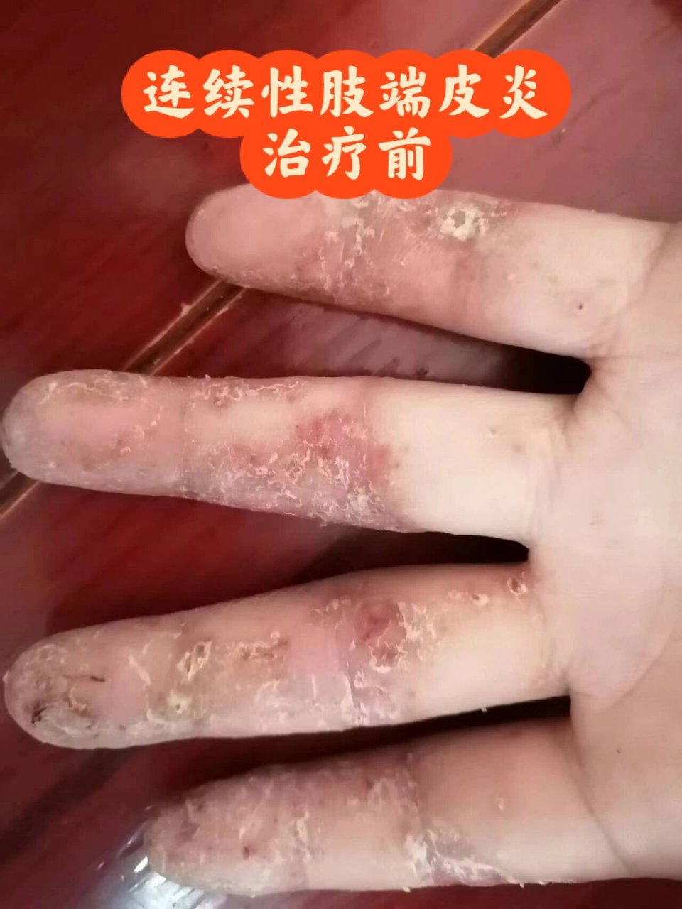 肢端性皮炎 治愈图片