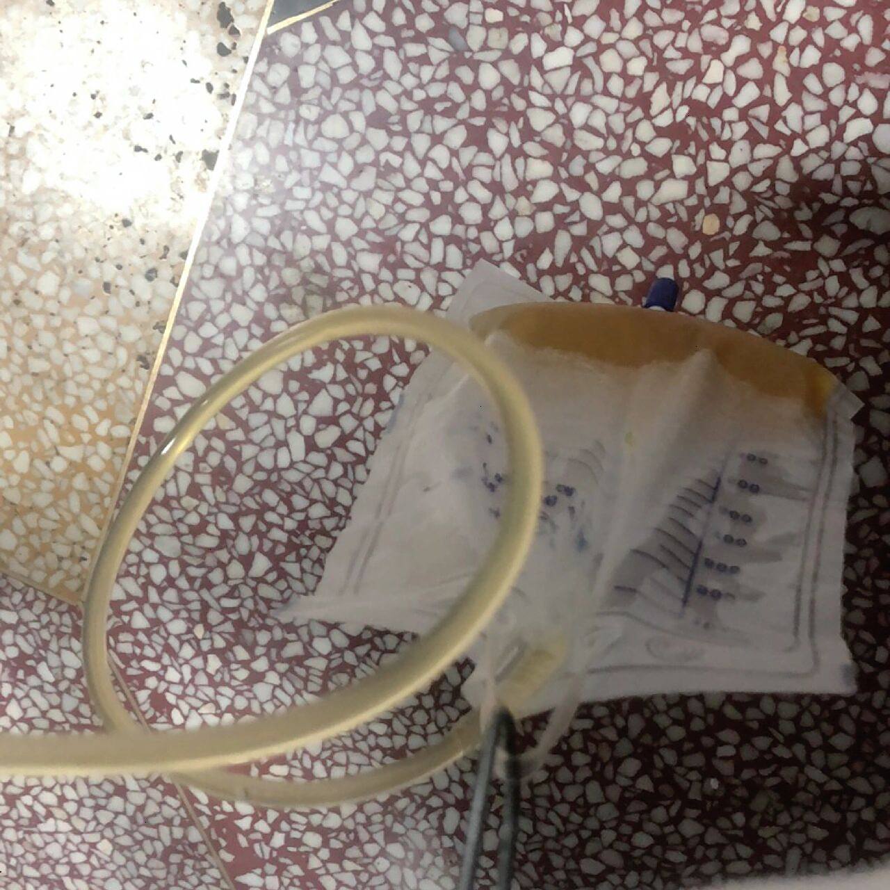 太痛苦了98肺积液抽水