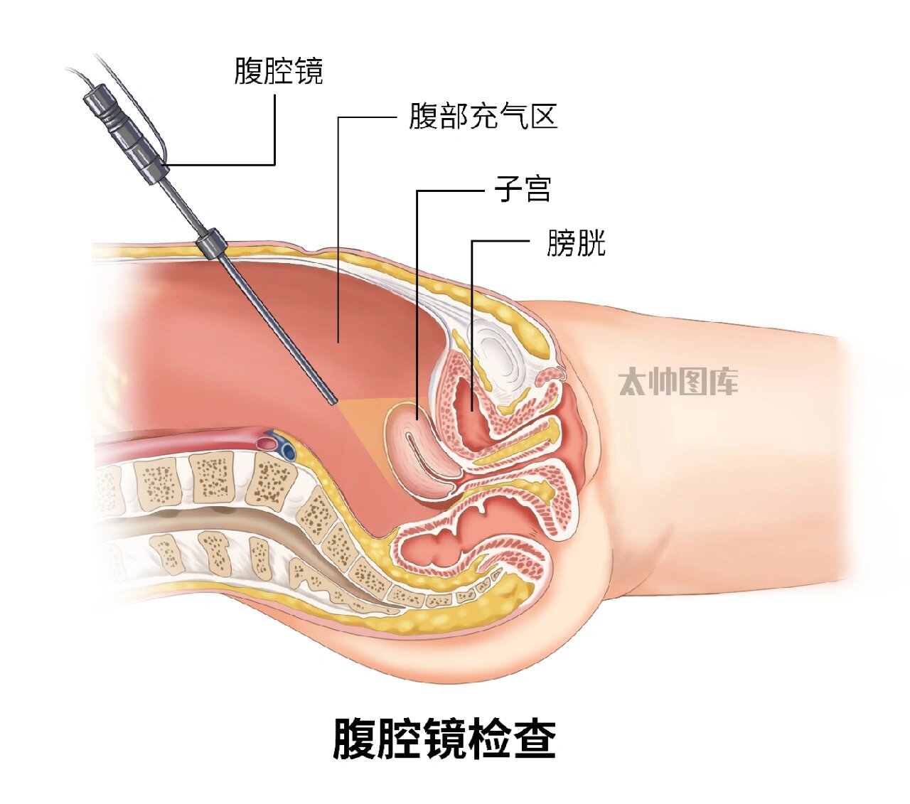 异位妊娠图片部位图片