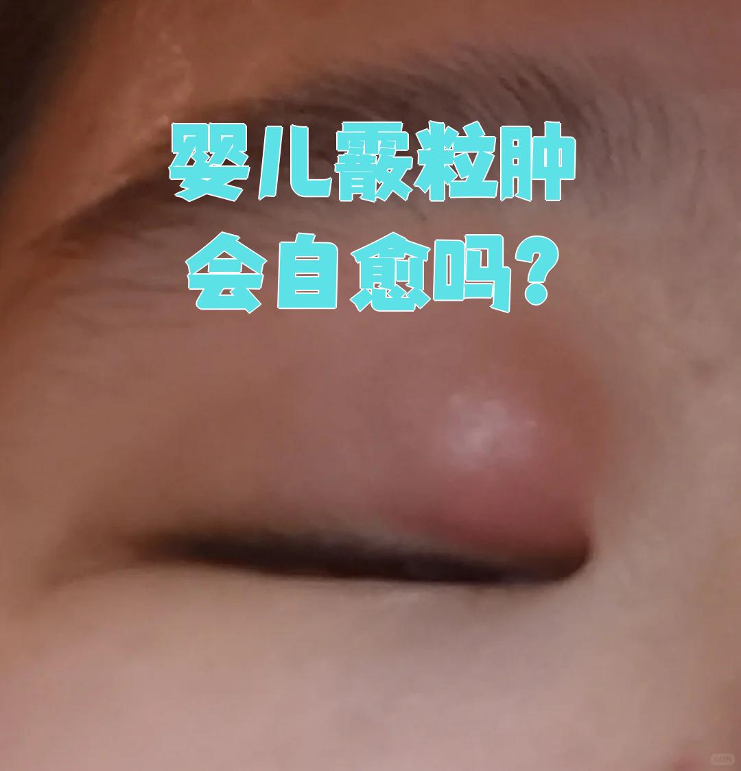 婴儿霰粒肿确实有可能自己好,但家长不能掉以轻心,因为每个孩子的