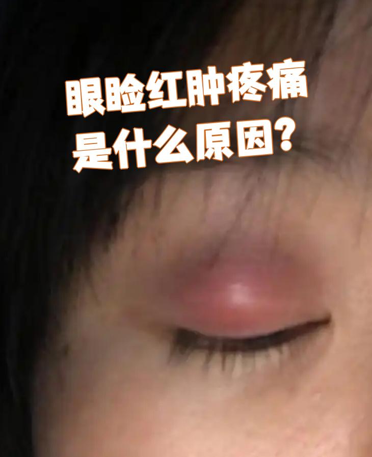 眼睑红肿疼痛最常见的原因是麦粒肿,霰粒肿和眼眶蜂窝组织炎
