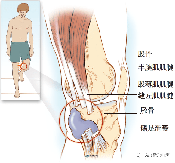 鹅足腱滑囊炎康复训练图片