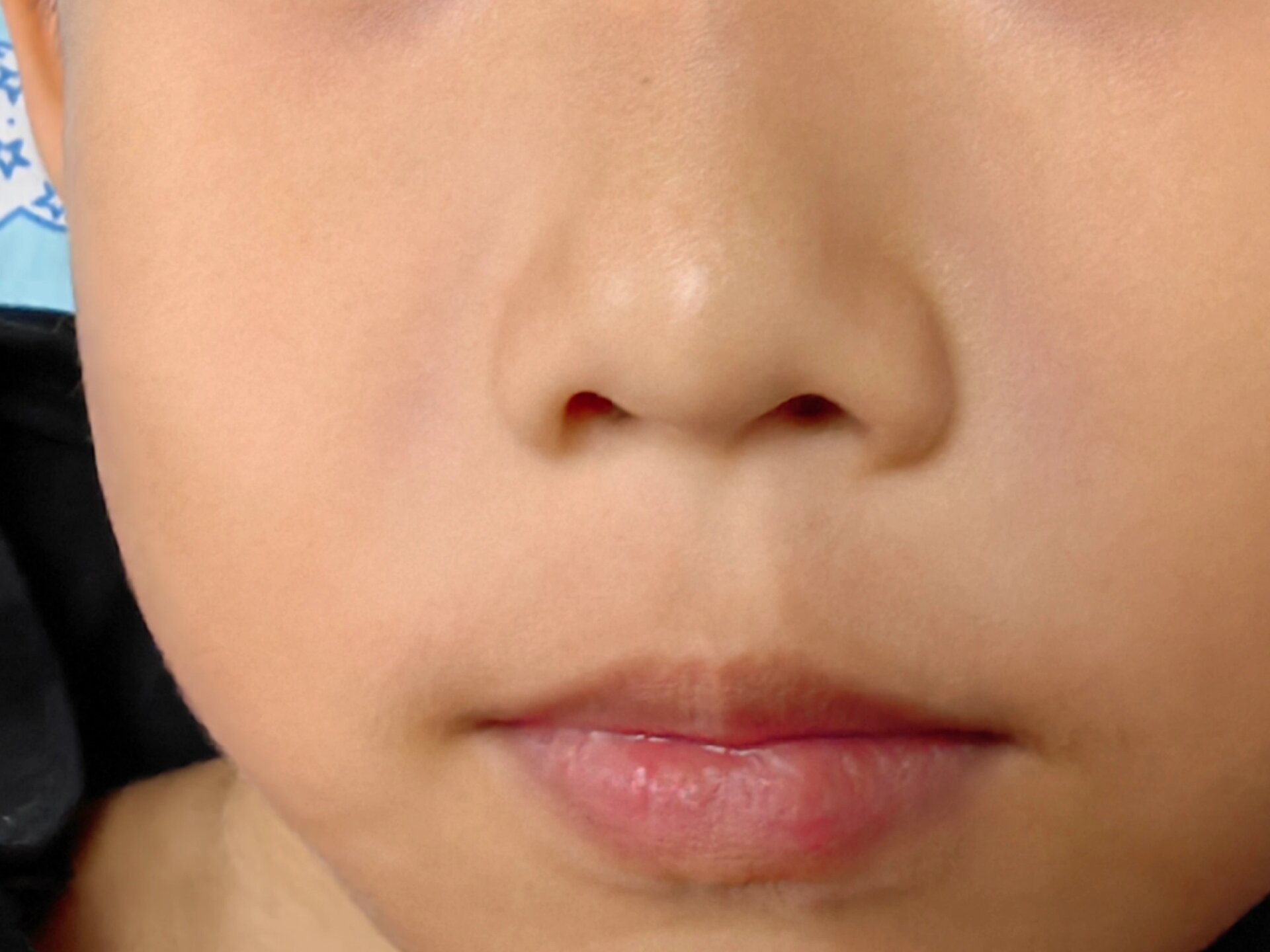 不懂就问,孩子鼻翼两侧泛两紫色,怎么回事  鼻翼两侧发青,怎么回事?